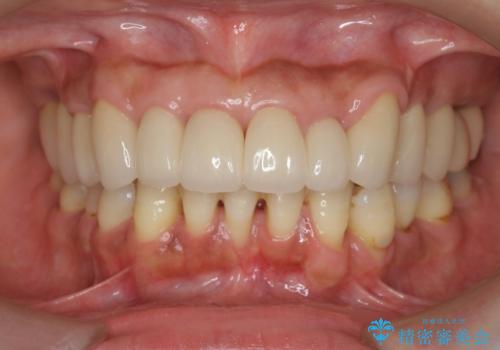 [ 再生治療・歯周外科・小矯正・セラミック補綴 ]  前歯の歯周病治療の治療後