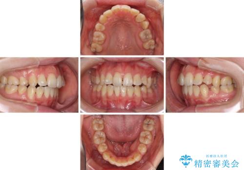 裏側矯正の途中で海外へ インビザライン・チェンジによる矯正治療の治療中
