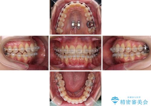 【モニター】急速拡大装置 狭い歯列を拡大してワイヤー装置で短期間治療の治療中