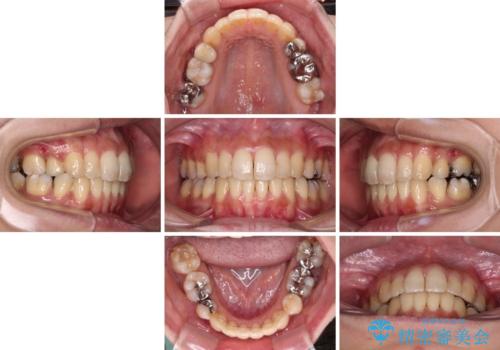 後戻りで突出した前歯をインビザラインで解消の治療中