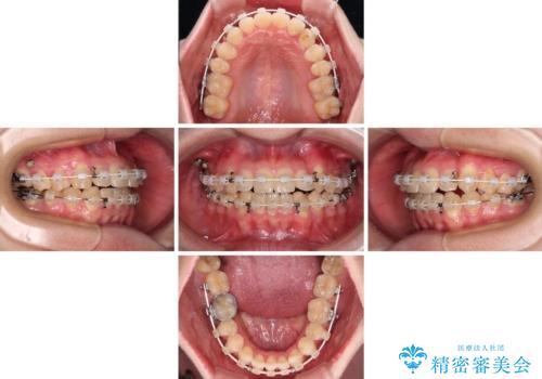 【モニター】1本欠損した下顎前歯と上顎の八重歯 ワイヤー装置で楽して矯正治療の治療中