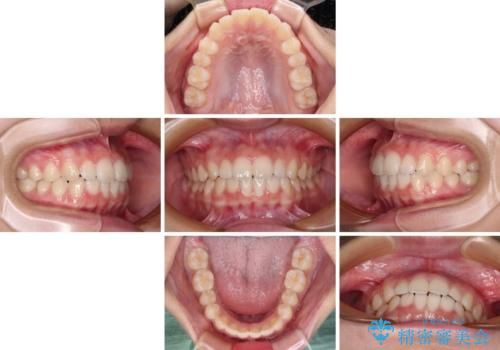 前歯のデコボコを治したい 高校生のインビザライン治療の治療中