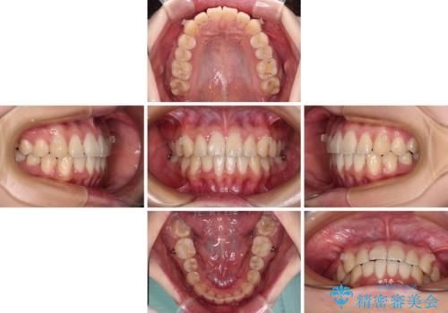 【モニター】捻れた前歯をスッキリと インビザライン矯正治療の治療中