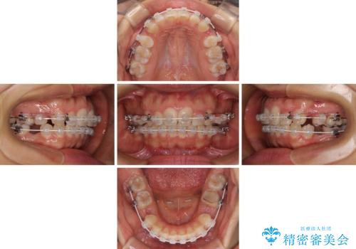 【モニター】閉じにくい口元 ワイヤー装置での抜歯矯正の治療中