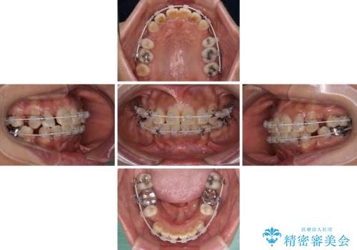 クロスバイトの前歯を治したい ワイヤー装置でも抜歯矯正の治療中