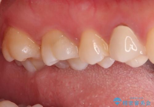 【VPT(歯髄温存療法)とセラミックインレー】深い虫歯でも神経を残したいの治療後
