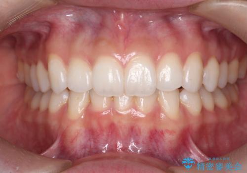 歯を抜かずに後方移動で達成する、前突感の改善の症例 治療後