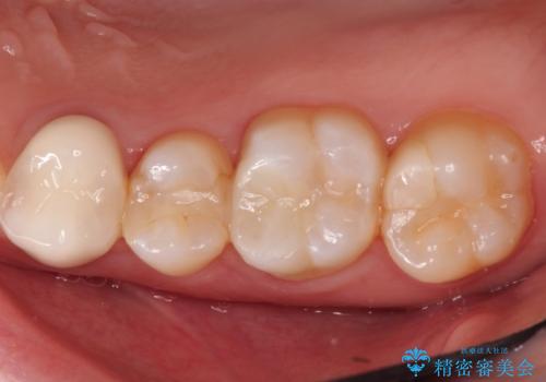 【VPT(歯髄温存療法)とセラミックインレー】深い虫歯でも神経を残したいの症例 治療後