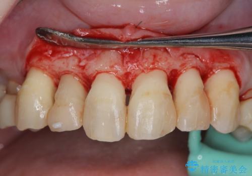 多発した前歯の重度虫歯治療の治療中