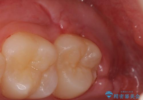 親知らずを抜きたいの治療後