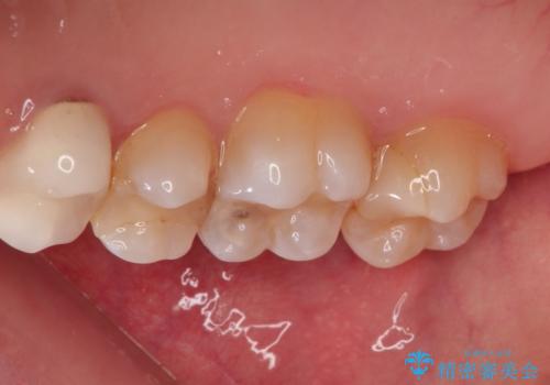 【VPT(歯髄温存療法)とセラミックインレー】深い虫歯でも神経を残したいの治療前