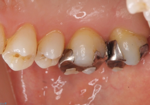 銀歯を白くしたい　セラミッククラウンでの治療の治療前