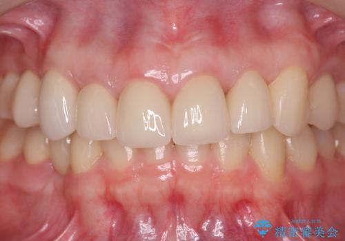 多発した前歯の重度虫歯治療の治療後