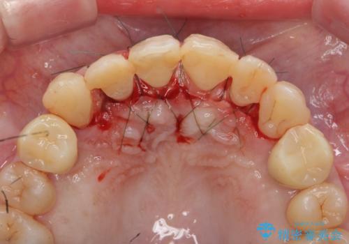 多発した前歯の重度虫歯治療の治療中