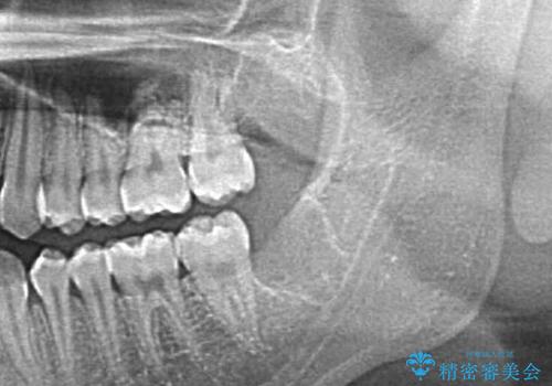 親知らずを抜きたいの治療後