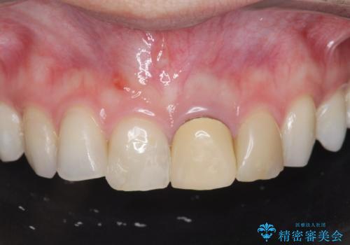 前歯の見た目を改善 セラミック審美治療の症例 治療前