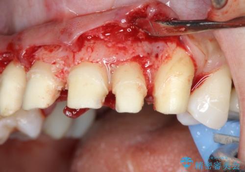 [ 再生治療・歯周外科・小矯正・セラミック補綴 ]  前歯の歯周病治療の治療前