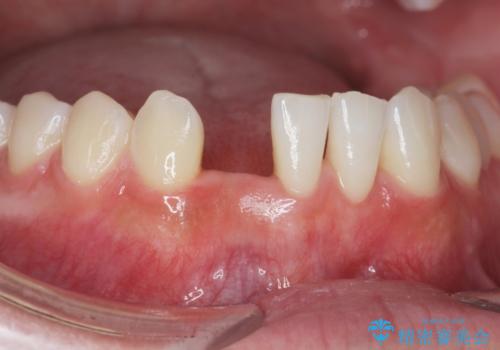 [ 先天性の前歯欠損 ]　矯正とインプラントの包括治療の症例 治療前