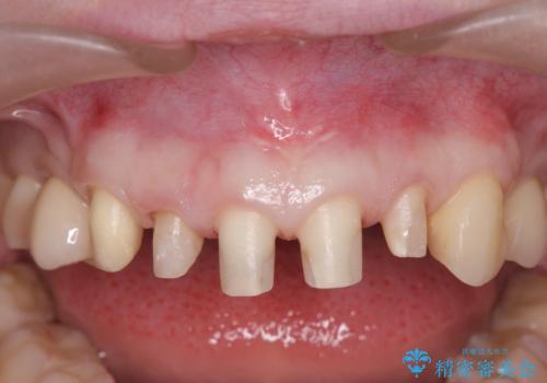 多発した前歯の重度虫歯治療の治療中