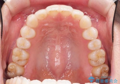 歯を抜かずに後方移動で達成する、前突感の改善の治療後