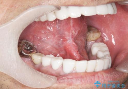 [ 舌小帯の形成 ]  滑舌をよくしたいの症例 治療後