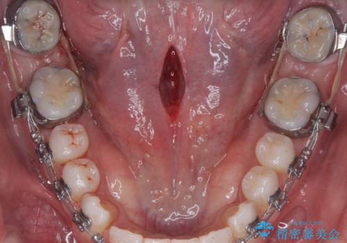 舌小帯の切除の治療中