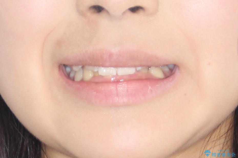 【審美ワイヤー】前歯が見えない。深い噛み合わせの治療の治療前（顔貌）