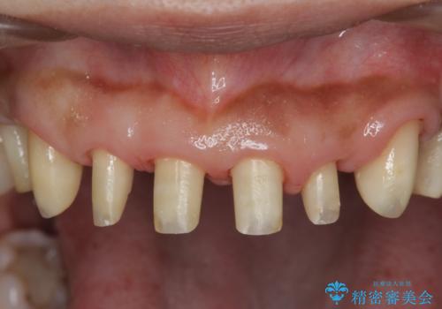 [ 再生治療・歯周外科・小矯正・セラミック補綴 ]  前歯の歯周病治療の治療中