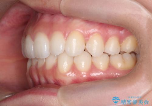 歯を抜かずに後方移動で達成する、前突感の改善の治療後