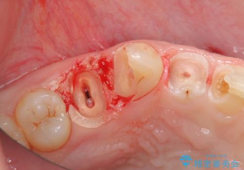 多発した前歯の重度虫歯治療の治療前