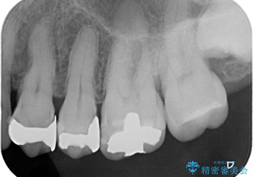 【オールセラミッククラウン】銀歯の下に大きな虫歯の治療前