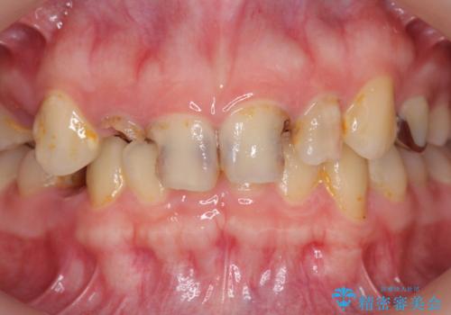 多発した前歯の重度虫歯治療の治療前