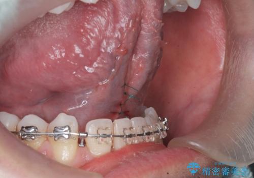 舌小帯の切除の治療中