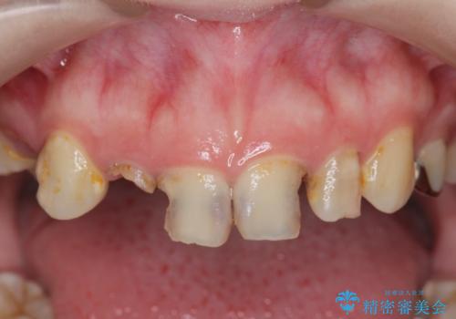 多発した前歯の重度虫歯治療の治療前