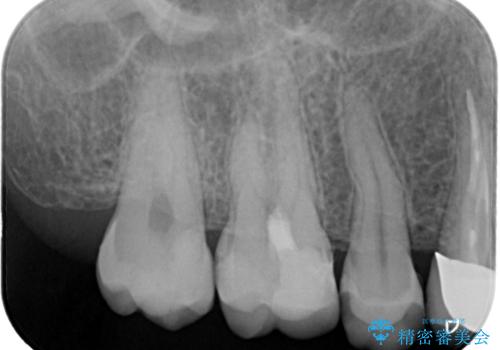 【VPT(歯髄温存療法)とセラミックインレー】深い虫歯でも神経を残したいの治療後