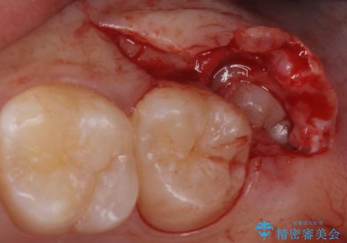 親知らずを抜きたいの治療中