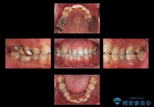 短期間で歯並びをきれいにしたい セラミックでかぶせる治療でも良いの治療前