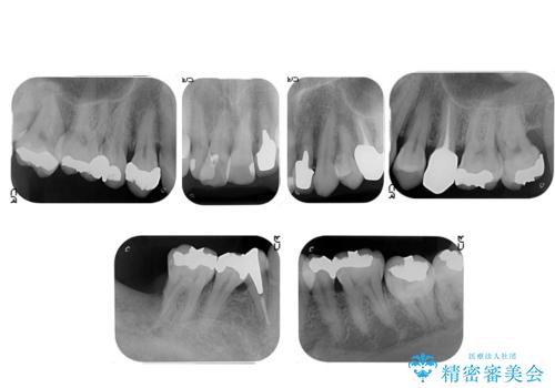 受け口 なんと部分矯正で治るんです!! インプラントを含めた総合歯科治療の治療前