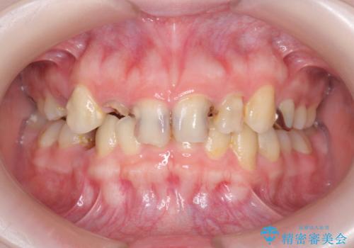 多発した前歯の重度虫歯治療の治療前