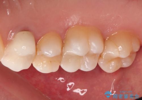 【VPT(歯髄温存療法)とセラミックインレー】深い虫歯でも神経を残したいの治療後