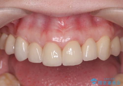 多発した前歯の重度虫歯治療の治療後