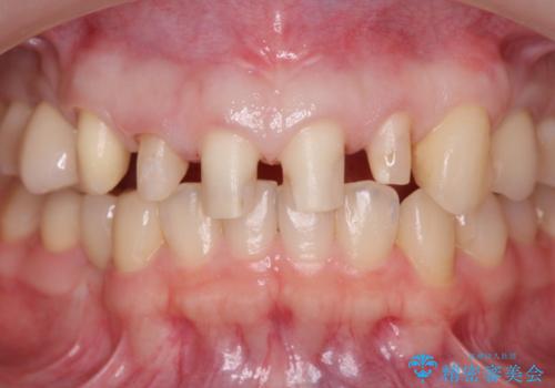 多発した前歯の重度虫歯治療の治療中