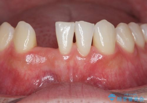 [ 先天性の前歯欠損 ]　矯正とインプラントの包括治療の治療前