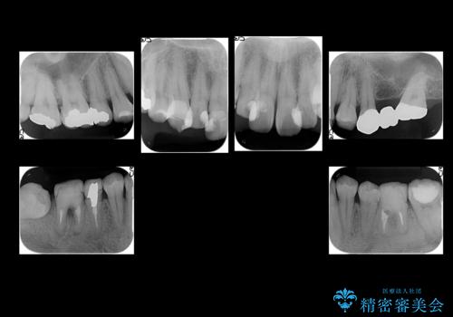 短期間で歯並びをきれいにしたい セラミックでかぶせる治療でも良いの治療前