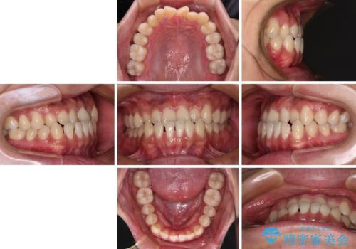 前歯のクロスバイトをワイヤー矯正で 結婚式までに治したいの治療前