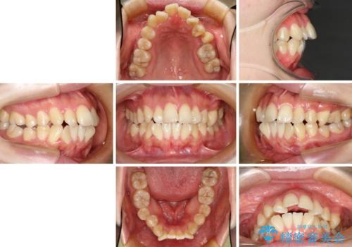 裏側矯正の途中で海外へ インビザライン・チェンジによる矯正治療の治療前