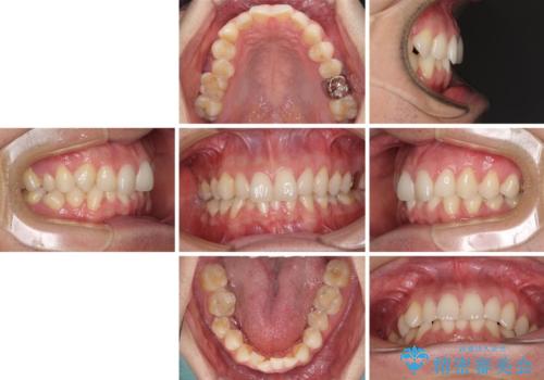 ディープバイトと叢生　インビザラインによる矯正治療の治療前