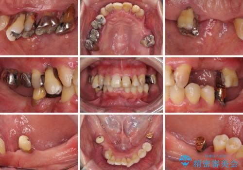 歯周病で痛い 全顎的歯周病治療の治療前