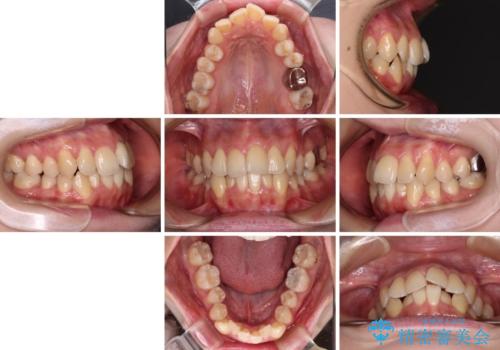 【モニター】急速拡大装置 狭い歯列を拡大してワイヤー装置で短期間治療の治療前