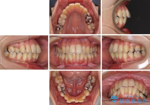 後戻りで突出した前歯をインビザラインで解消の治療前